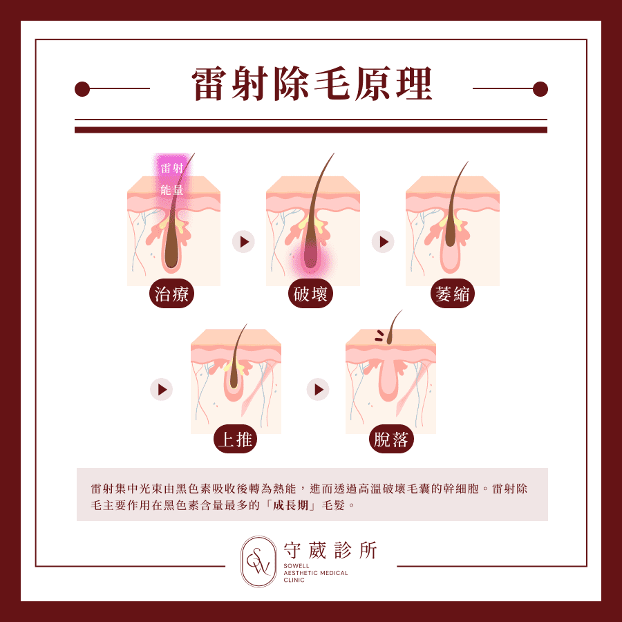 雷射除毛原理