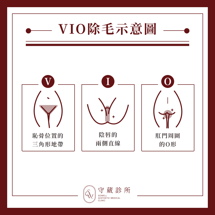 VIO除毛示意